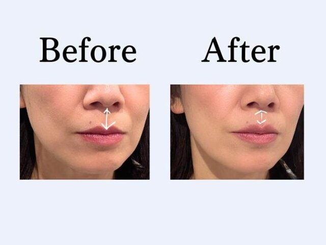 鼻の下 ビフォー アフター
