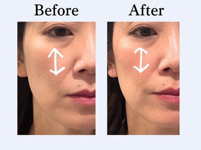 目の下 ビフォー アフター