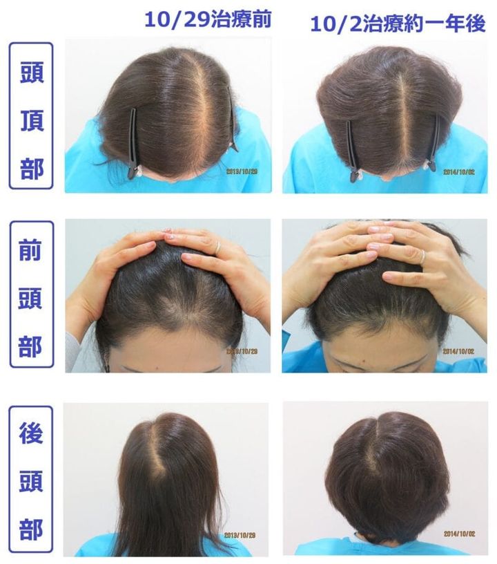 クレア―ジュクリニック東京での薄毛治療の例