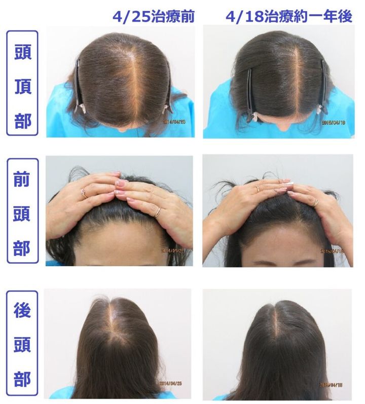 クレア―ジュクリニック東京での薄毛治療の例