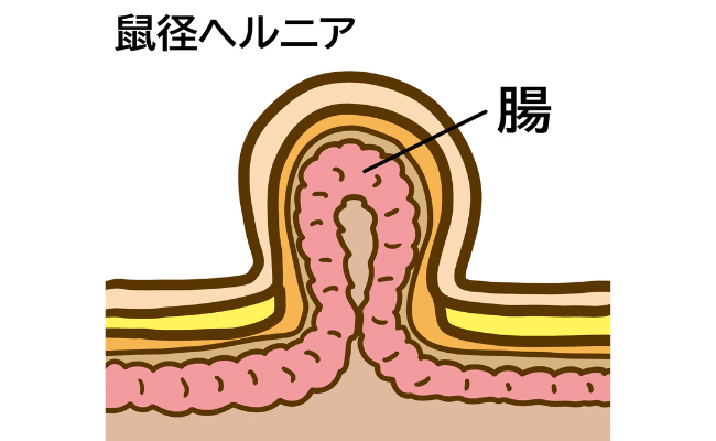 鼠径ヘルニア①
