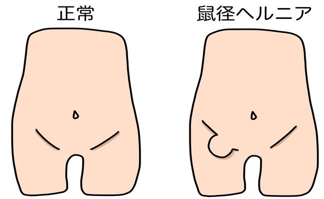 鼠径ヘルニア①