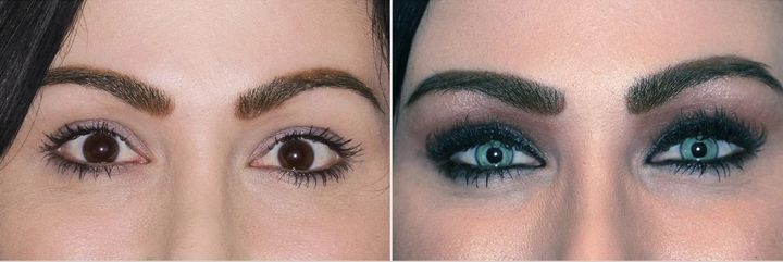 目の色を変える1万2000ドルの手術が人気急上昇中