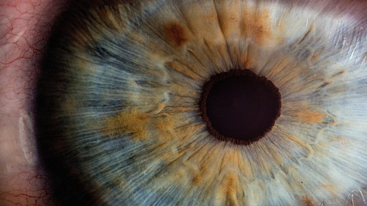 目の色を変える1万2000ドルの手術が人気急上昇中