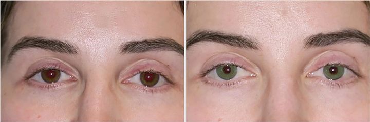 目の色を変える1万2000ドルの手術が人気急上昇中