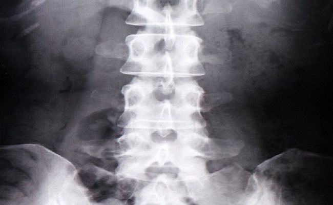 レントゲン写真