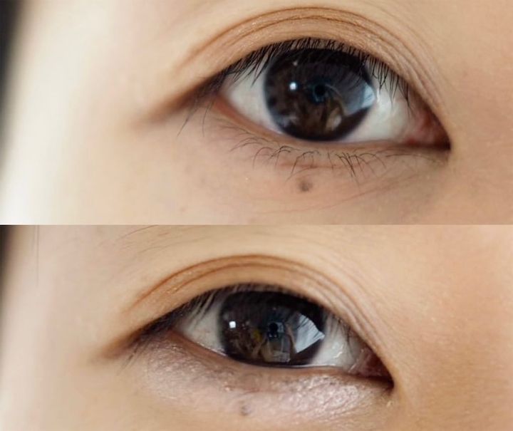 ダブルエンド涙袋メーカー