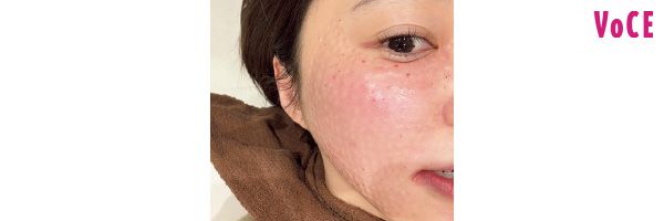 ダウンタイム中。エンボスと呼ばれるゴルフボールみたいなブツブツがキレイに出てる