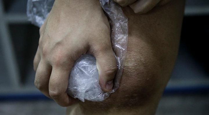 女子選手に多い前十字靭帯断裂、調査研究に資金提供 「月経前に筋肉損傷が6倍増」と昨年判明