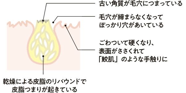 古い角質が毛穴につまっている 毛穴が締まらなくなってぽっかり穴があいている ごわついて硬くなり、表面がささくれて「鮫肌」のような手触りに 乾燥による皮脂のリバウンドで皮脂つまりが起きている