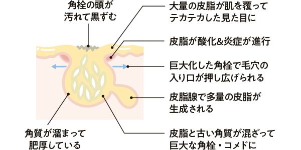 角栓の頭が汚れて黒ずむ 大量の皮脂が肌を覆ってテカテカした見た目に 皮脂が酸化＆炎症が進行 巨大化した角栓で毛穴の入り口が押し広げられる 皮脂腺で多量の皮脂が生成される 角質が溜まって肥厚している 皮脂と古い角質が混ざって巨大な角栓・コメドに