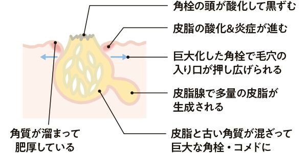 角栓の頭が酸化して黒ずむ 皮脂の酸化&炎症が進む 巨大化した角栓で毛穴の入り口が押し広げられる 皮脂腺で多量の皮脂が生成される 角質が溜まって肥厚している 皮脂と古い角質が混ざって巨大な角栓・コメドに