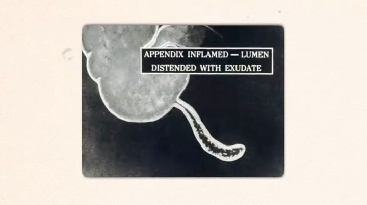 盲腸の先端にぶら下がっているのが「虫垂」