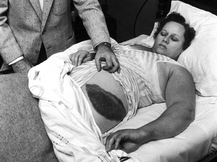 隕石の衝突で横腹にアザを負ったホッジスさん（1920〜1972）