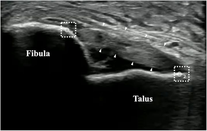 “たかが捻挫”を覆すエビデンス