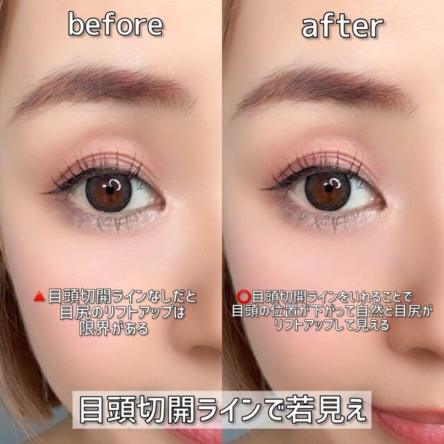 目頭切開ラインで若見え ビフォー アフター