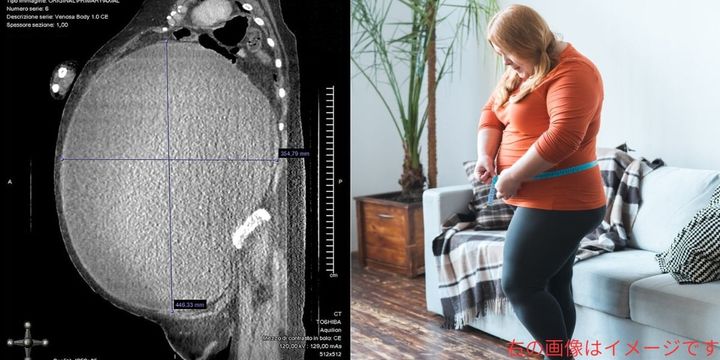 5キロの巨大腫瘍を「ただの太り過ぎ」と勘違いし放置してしまった女性