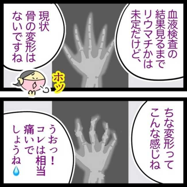 手指のこわばり／へそ