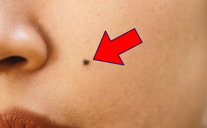 「悪いほくろ」は病気の可能性も…？ ※画像はイメージ