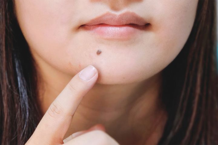 ホクロ、どうする？