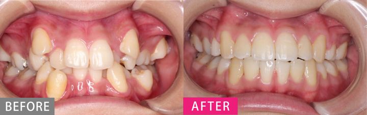 【大人の歯列矯正】クリニック選び・老け問題・後戻りetc.疑問を徹底解説！