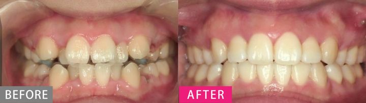 【大人の歯列矯正】クリニック選び・老け問題・後戻りetc.疑問を徹底解説！