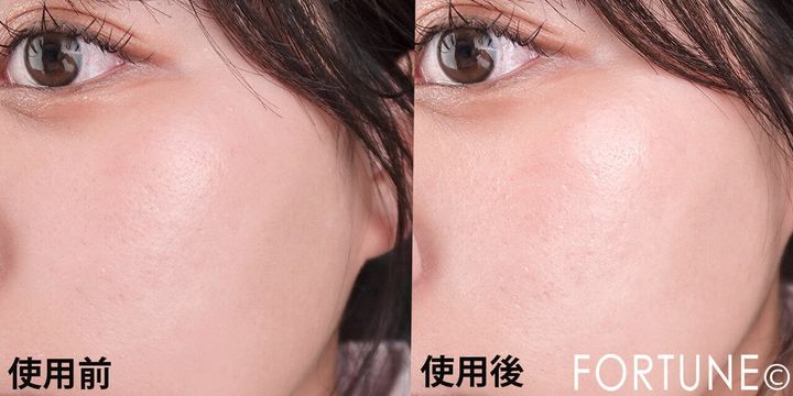 クオリティファースト ダーマレーザーイレイズVC