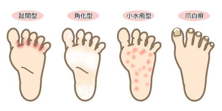 足のトラブル「水虫」は見逃すな