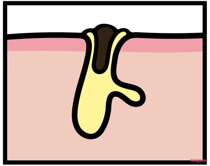 「頑固な黒ずみ毛穴」のおすすめ成分、NGケアをレクチャー。なかなか落ちない場合は産毛の可能性も？_3