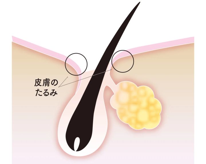 毛穴がたるむ原因とは？