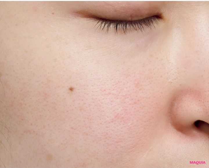 炎症による「ダメージ毛穴」は鎮静が最優先！ ビタミンCのシートマスクも有効_9_1