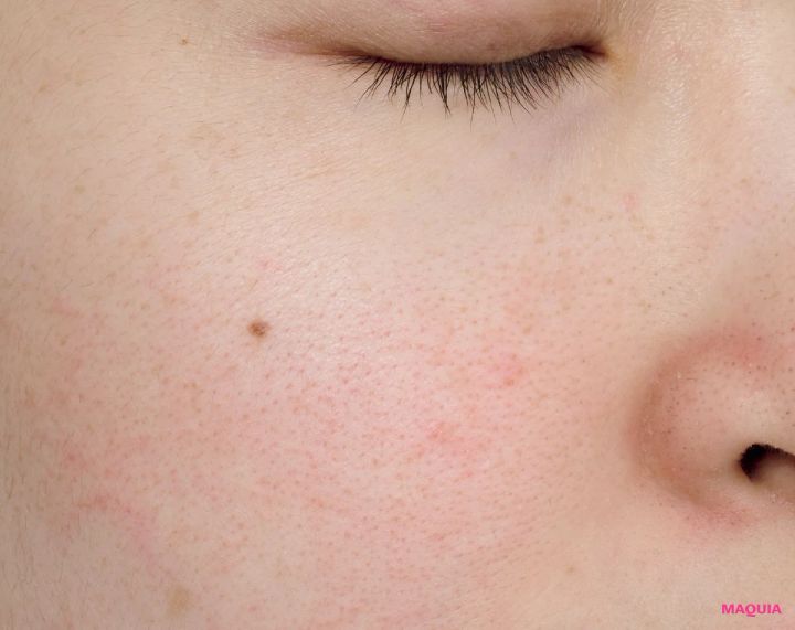 炎症による「ダメージ毛穴」は鎮静が最優先！ ビタミンCのシートマスクも有効_9_2