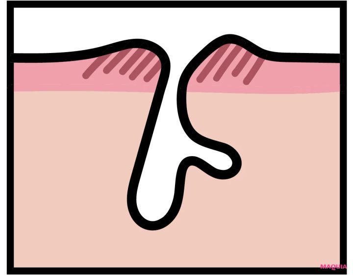 炎症による「ダメージ毛穴」は鎮静が最優先！ ビタミンCのシートマスクも有効_3