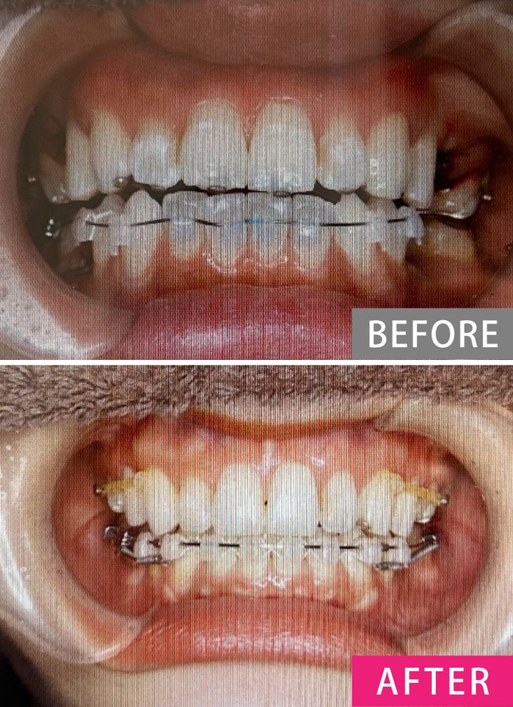 【歯列矯正の体験談】「歯がキレイな人」に聞く、クリニック選びのコツ・やってよかったこと・後悔したこと