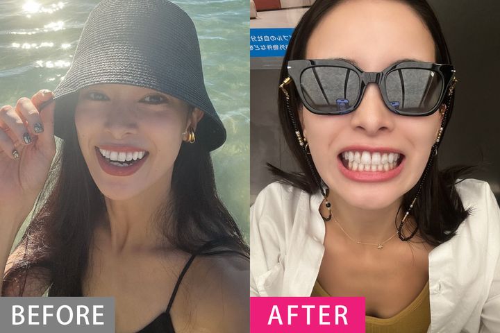 【歯列矯正の体験談】「歯がキレイな人」に聞く、クリニック選びのコツ・やってよかったこと・後悔したこと