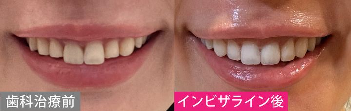 【歯列矯正の体験談】「歯がキレイな人」に聞く、クリニック選びのコツ・やってよかったこと・後悔したこと