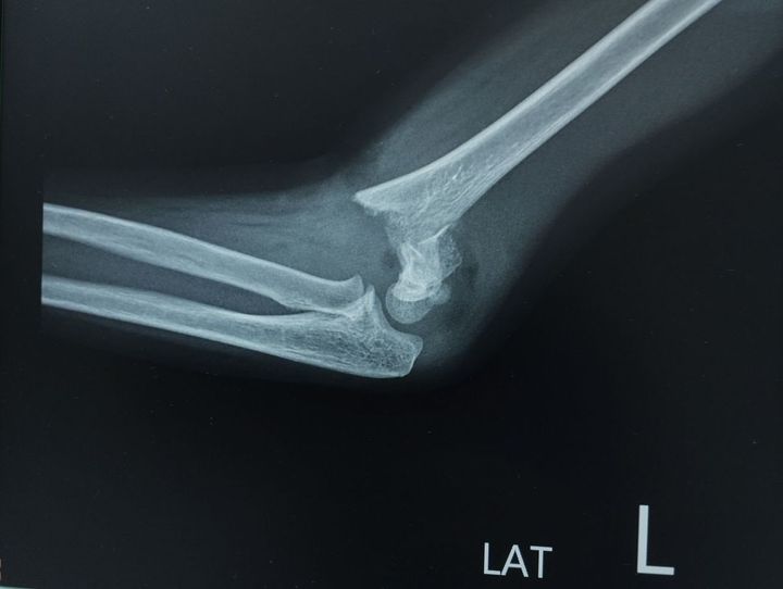 左肘のレントゲン写真