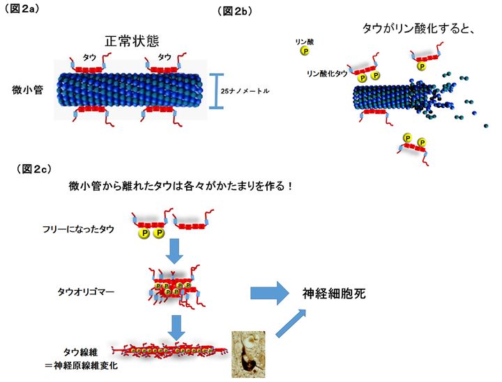 リン酸化したタウタンパク質はアルツハイマー病の原因になり得ます