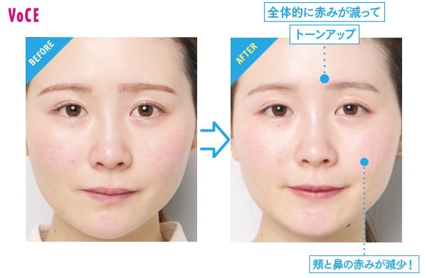 BEFORE→AFTER 全体的に赤みが減ってトーンアップ 頬と鼻の赤みが減少！