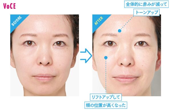BEFORE→AFTER 全体的に赤みが減ってトーンアップ リフトアップして頬の位置が高くなった