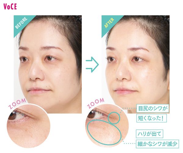 BEFORE→AFTER ZOOM 目尻のシワが短くなった！ ハリが出て細かなシワが減少