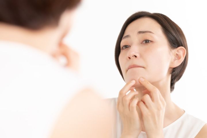 顔の「Uゾーン」にニキビができる原因は？（画像はイメージ）