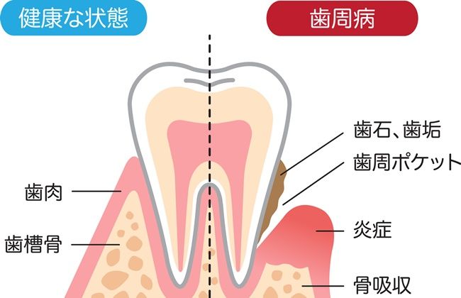 歯周病