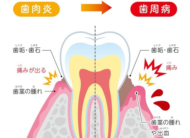 歯周病