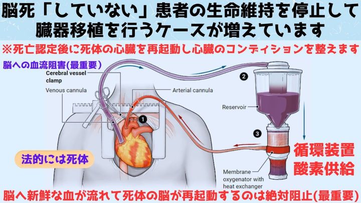 体内常温灌流法（NRP）