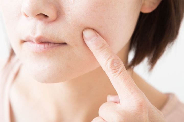 ニキビの「色」で進行度が分かる？