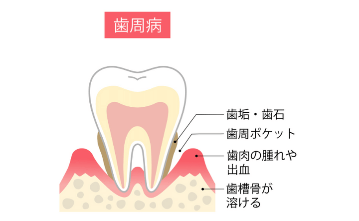 「歯周病」が「認知症」と関係あるって本当？ 将来的なリスクに備えて知っておきたい基礎知識【医師解説】