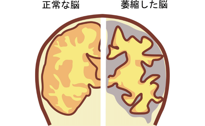 「歯周病」が「認知症」と関係あるって本当？ 将来的なリスクに備えて知っておきたい基礎知識【医師解説】