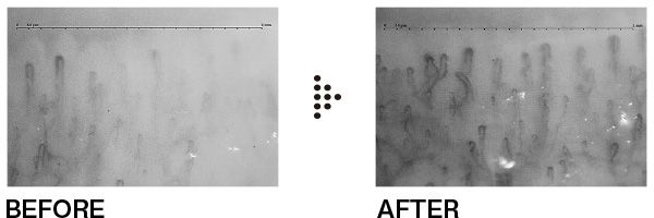 健康な証拠の“ヘアピン状の血管”が出現！