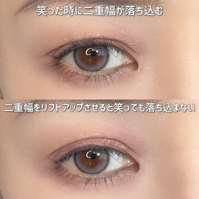 二重まぶたをリフトアップさせる